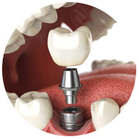 orlando dental services - dental implants