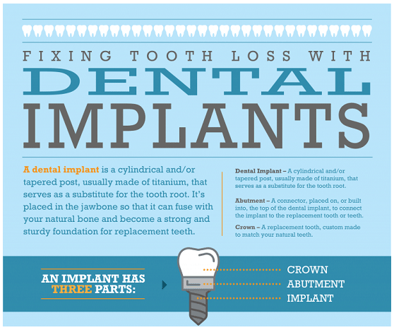 dental implants orlando